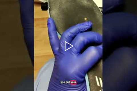 How to prevent calluses and corns from returning
