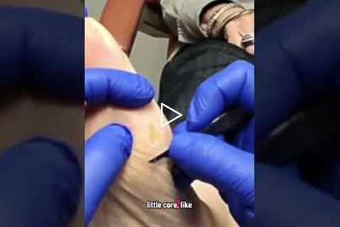 How to remove calluses and corns