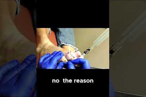 How Toe Deformities Cause Calluses and What Y